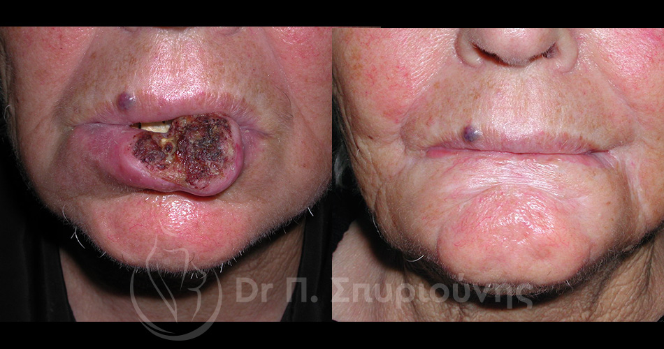 Καρκίνωμα κάτω χείλους πριν και μετά την αποκατάσταση